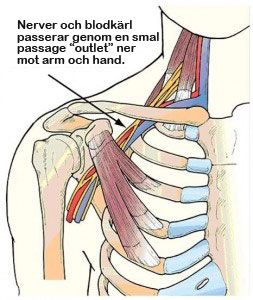 Thoracic Outlet Syndrom